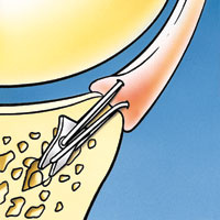 hirslanden-die-schmerzhafte-schulter-6