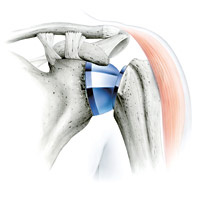 hirslanden-die-schmerzhafte-schulter-7