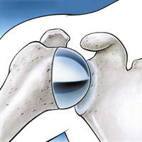 hirslanden-die-schmerzhafte-schulter-8