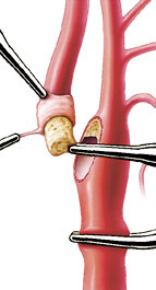 hirslanden-ein-kurzer-eingriff-hilft-schlaganfaelle-zu-vermeiden-2