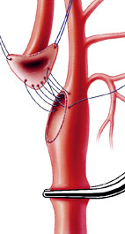 hirslanden-ein-kurzer-eingriff-hilft-schlaganfaelle-zu-vermeiden-3