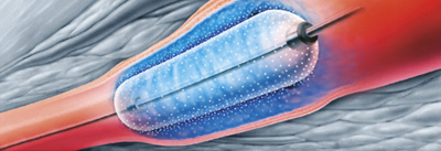 hirslanden-einsatz-von-ballonkatheter-und-stent-in-den-beinen-1