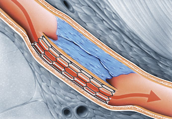 hirslanden-einsatz-von-ballonkatheter-und-stent-in-den-beinen-2