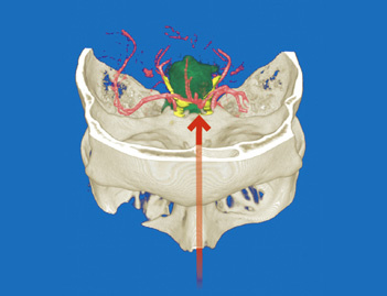 hirslanden-entfernung-eines-gehirntumors-2