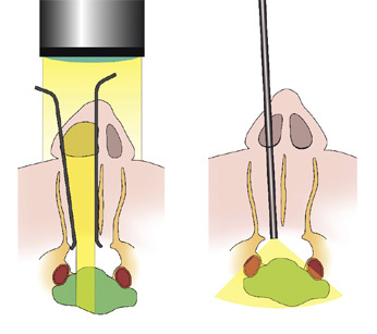 hirslanden-entfernung-eines-gehirntumors-3