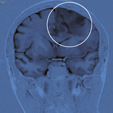 hirslanden-entfernung-von-hirntumoren-1