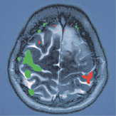 hirslanden-entfernung-von-hirntumoren-3
