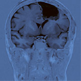 hirslanden-entfernung-von-hirntumoren-4