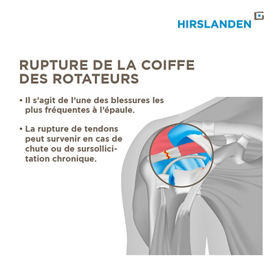 Infographique rupture de la coiffe des rotateurs