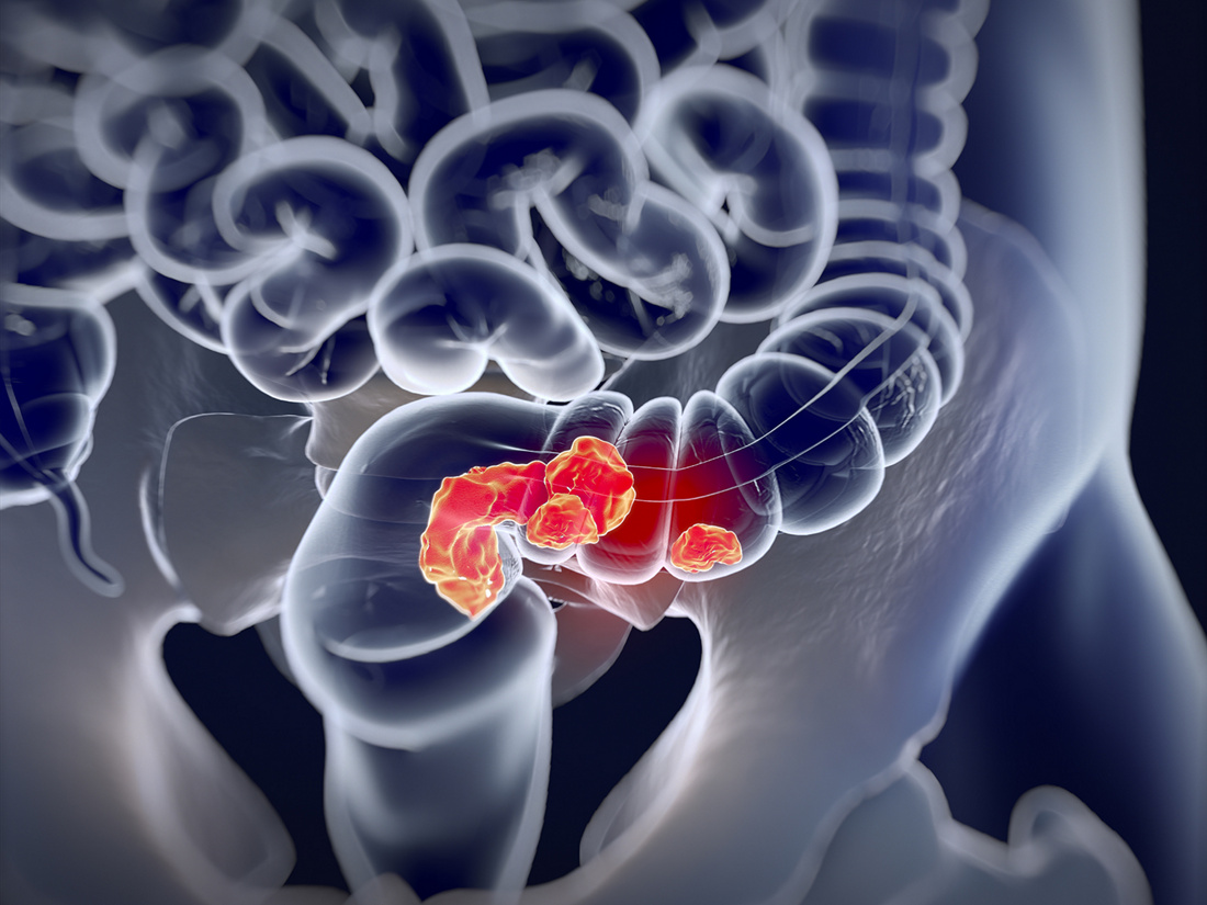Bowel cancer | Hirslanden