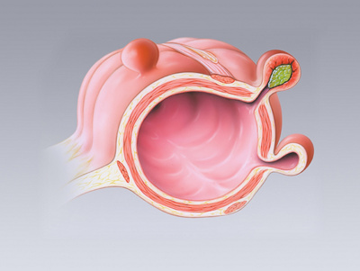 Illustration Darmdivertikel