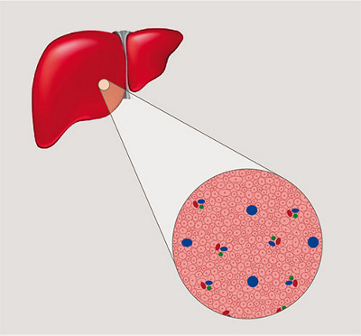 hirslanden-fettleber-1