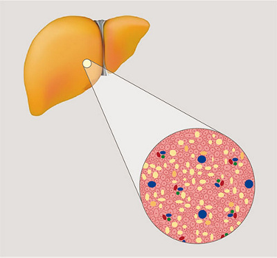 hirslanden-fettleber-2
