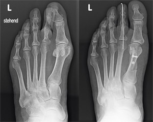 hirslanden-fuss-schmerzen-bei-hallux-valgus-1