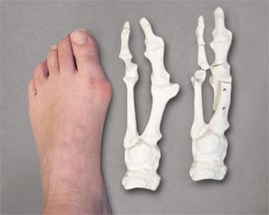Hallux valgus, the ganglion on the big toe: Conservative treatment or  surgery?