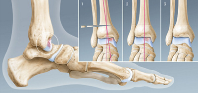 hirslanden-gelenkerhaltende-obere-sprunggelenkchirurgie-1