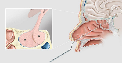 hirslanden-gutartige-tumoren-der-hirnanhangsdruese-1