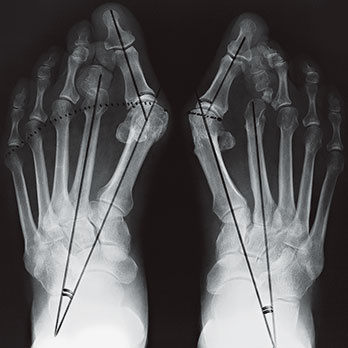 hirslanden-haeufige-vorfussprobleme-und-deren-therapiemoeglichkeiten-1