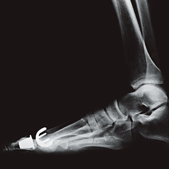 hirslanden-haeufige-vorfussprobleme-und-deren-therapiemoeglichkeiten-2