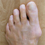 Wegmassieren hallux Hallux valgus: