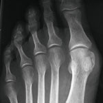 hirslanden-hallux-valgus-2