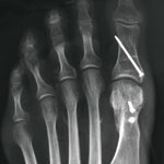hirslanden-hallux-valgus-3