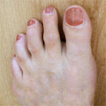 hirslanden-hallux-valgus-4