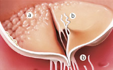 hirslanden-herausforderungen-der-modernen-mitralklappenrekonstruktion-1
