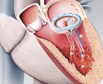 hirslanden-herausforderungen-der-modernen-mitralklappenrekonstruktion-3