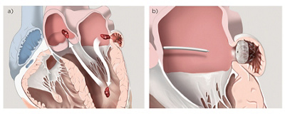 hirslanden-herz-schlaganfall-abbildung