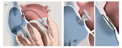 hirslanden-herz-schlaganfall-offenes-foramen-ovale