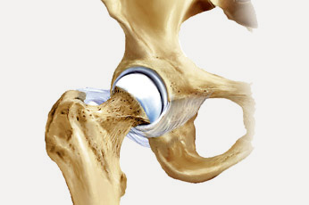 hirslanden-hueftschmerz-1