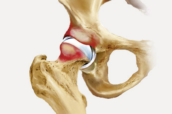 hirslanden-hueftschmerz-2