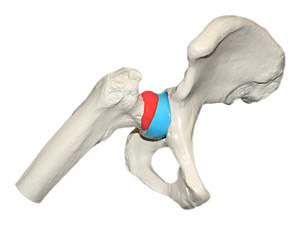 hirslanden-hueftschmerzen-beim-hueftimpingementsyndrom-1