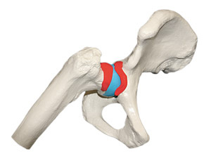 hirslanden-hueftschmerzen-beim-hueftimpingementsyndrom-2