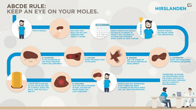 Infographic Keep an eye on your moles