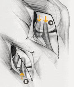 hirslanden-innenbandriss-des-kniegelenkes-2