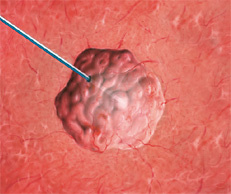 hirslanden-interventionelle-radiologie-3