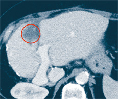 hirslanden-interventionelle-radiologie-4