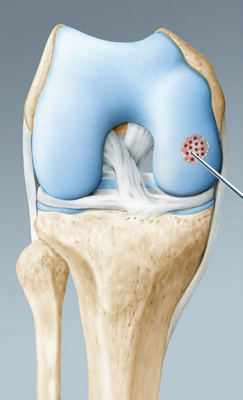 hirslanden-knorpelschaeden-im-knie-1