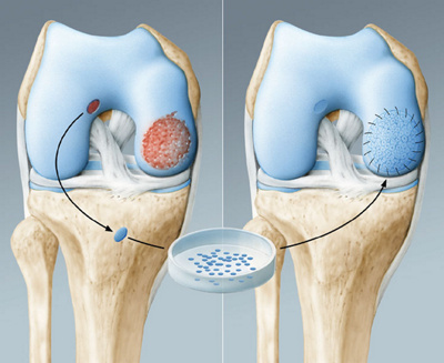 hirslanden-knorpelschaeden-im-knie-2