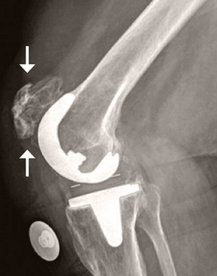 hirslanden-kuenstliche-gelenke-11