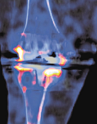 hirslanden-kuenstliche-gelenke-2