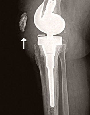 hirslanden-kuenstliche-gelenke-3