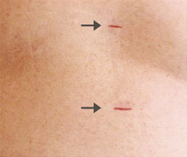 hirslanden-laparoskopische-chirurgie-zur-therapie-von-lebertumoren-1