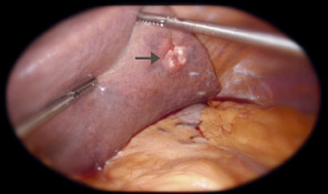 hirslanden-laparoskopische-chirurgie-zur-therapie-von-lebertumoren-2