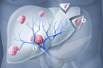 hirslanden-leber-und-pankreaskrebs-1