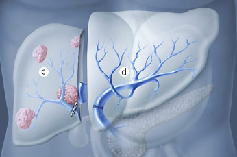hirslanden-leber-und-pankreaskrebs-2