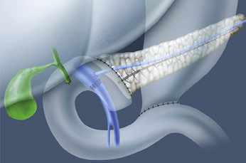 hirslanden-leber-und-pankreaskrebs-4