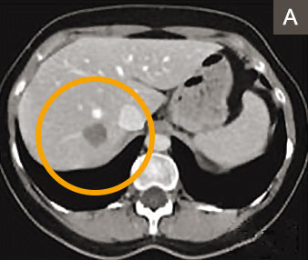 hirslanden-lebermetastasen-1
